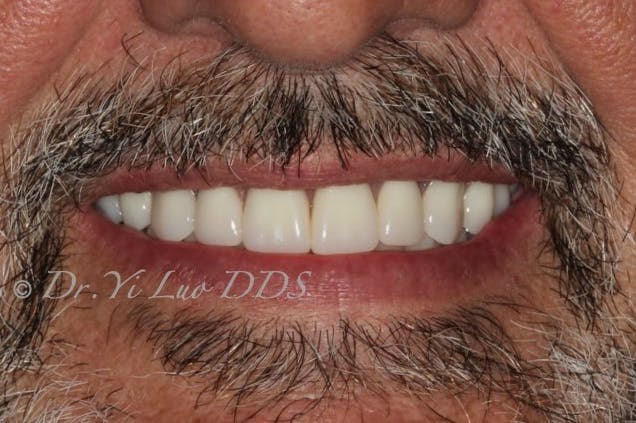 Upper Implant Overdenture and Lower Full Arch Fixed Implant Hybrid Prosthesis After