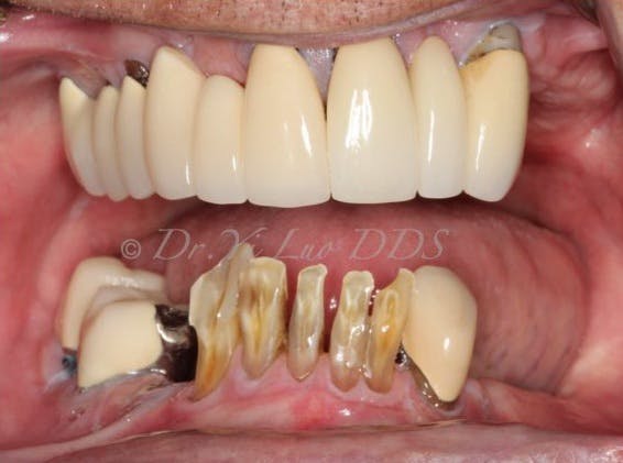Upper and Lower All-On-X Full Arch Fixed Zirconia Implant Prostheses Before
